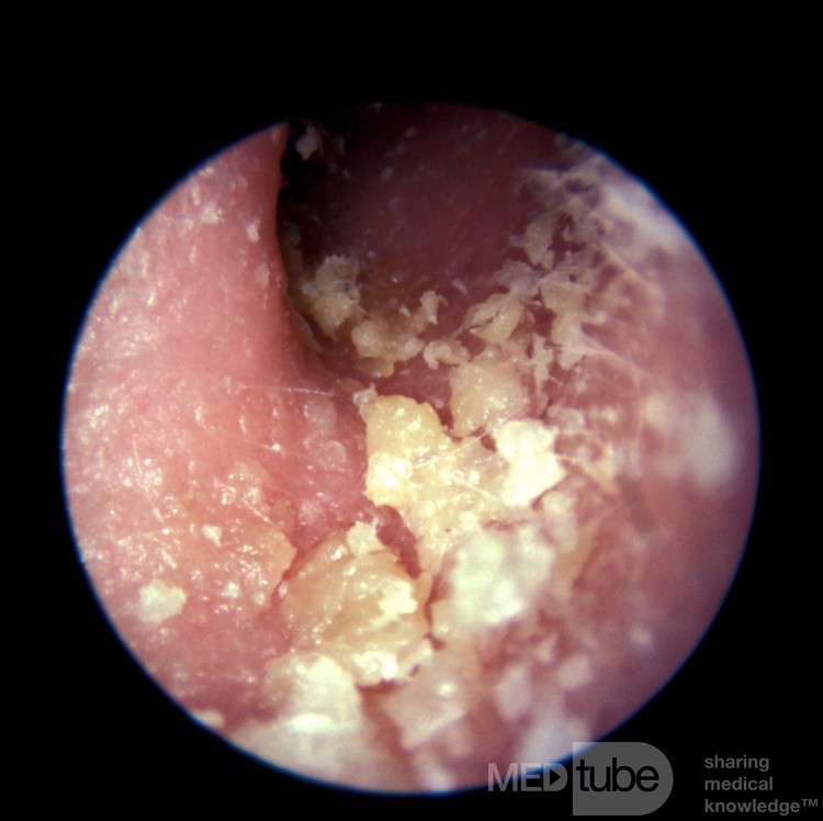Łuszczyca w przewodzie słuchowym zewnętrznym