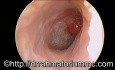 Polip attyki - prawdopodobny powód przedsionkowo - nadbębenkowego zapalenia ucha środkowego