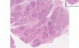Hiperplazja tkanek gruczołu piersiowego podczas ciąży - histopatologia piersi
