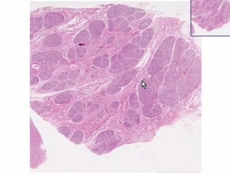 Hiperplazja tkanek gruczołu piersiowego podczas ciąży - histopatologia piersi