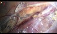 Jak wykonać operację żylaków powrózka nasiennego z zachowaniem tętnicy