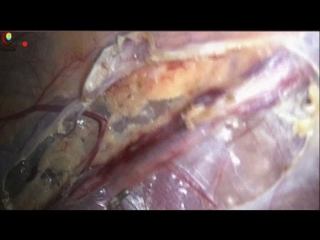 Jak wykonać operację żylaków powrózka nasiennego z zachowaniem tętnicy