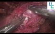 Reimplantacja moczowodu przy przeszczepie nerki