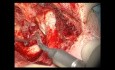 Retympanoplastyka typu otwartego ucha lewego z ossikuloplastyką typu SC  