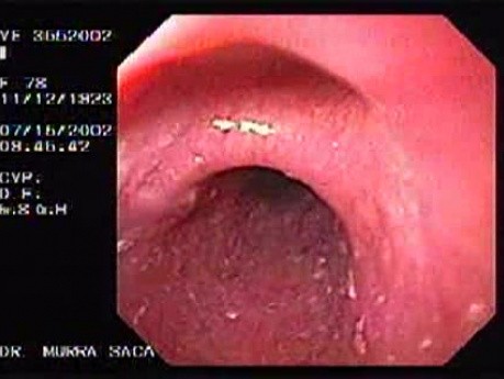 Mostki w obrębie błony śluzowej przełyku - obecność uchyłka