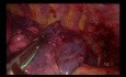 Wideotorakoskopowa lobektomia prawa górna z jednego cięcia podmostkowego w przypadku dużego guza z oskrzelem dodatkowym