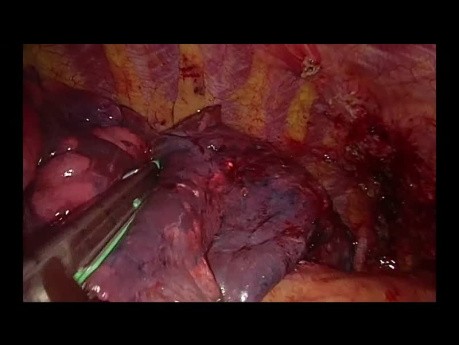 Wideotorakoskopowa lobektomia prawa górna z jednego cięcia podmostkowego w przypadku dużego guza z oskrzelem dodatkowym