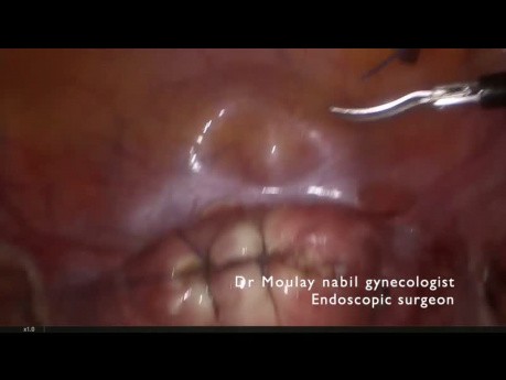 Szybka, bezpieczna laparoskopowa miomektomia 
