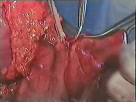 Operacja raka żołądka - gastrektomia subtotalna
