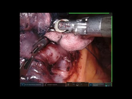 Lobektomia górna prawostronna z użyciem robota