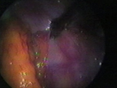 Pierwsze zaawansowane zabiegi laparoskopowe - dr Wetter