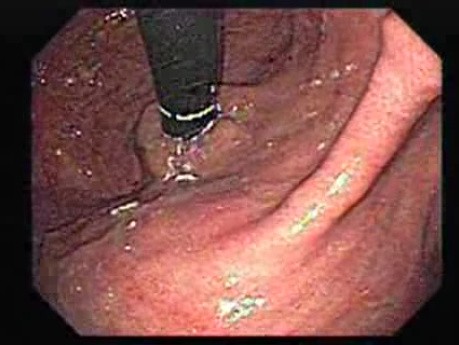 Zwężenie połączenia żołądkowo-przełykowego - obraz po inwersji końcówki endoskopu