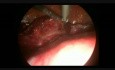 Histerektomia laparoskopowa dużego mięśniaka