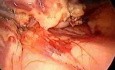 Dystalna pankreatektomia ze splenektomią