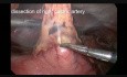 Laparoskopowo torakoskopowa esofagektomia