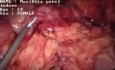 Appendektomia
