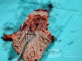 Gruczolakorak na podłożu przełyku Barrett'a - obraz endoskopowy (19 z 20)