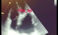 Tętniak aorty w echokardiografii