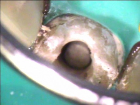 Oczyszczanie wierzchołka korzenia zęba pod mikroskopem