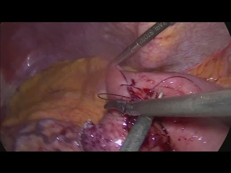 Konwersja OAGB (One anastomosis gastric bypass) do RYGB (Roux-en-Y Gastric Bypass)