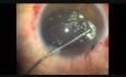 Tępy uraz oka. Witrektomia przednia fako, CTR, implantacja IOL