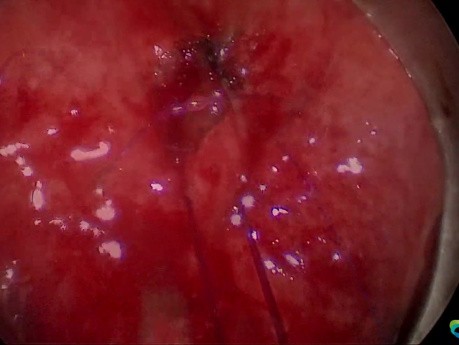 Przetoka odbytniczo-pęcherzowa po prostatektomii - leczenie chirurgią przezodbytniczą