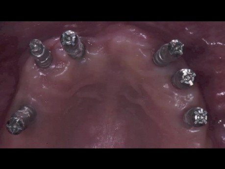 Implanty stomatologiczne zakładane za pomocą komputera