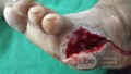 Amputacja palca V stopy 