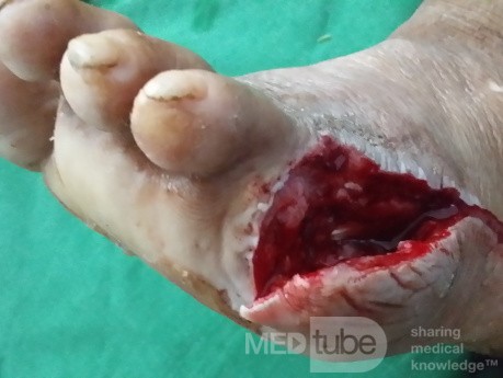 Amputacja palca V stopy 