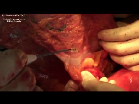 Izolowana resekcja głowy trzustki oraz duodenektomia z powodu GIST