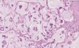 Rak koloidowy - histopatologia - pierś