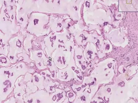 Rak koloidowy - histopatologia - pierś