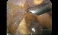Laparoskopowa cholecystektomia wykonana u pacjenta z historią otwartej operacji wątroby