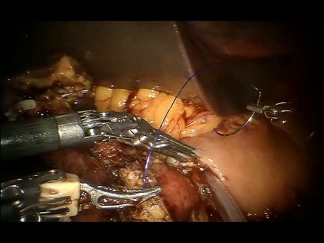 Jak powstaje zespolenie trzustkowo-żołądkowe podczas laparoskopowej operacji Whipple'a z użyciem robota