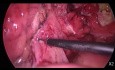 Operacja laparoskopowa w ostrym zapaleniu uchyłków - procedura Hartmanna