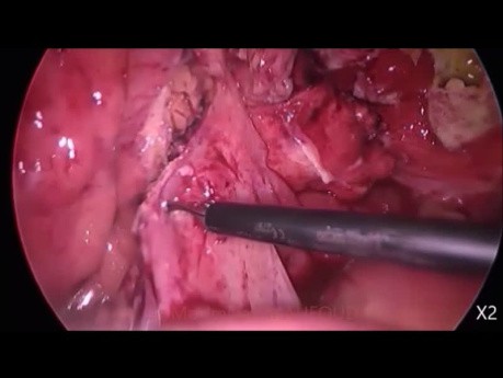 Operacja laparoskopowa w ostrym zapaleniu uchyłków - procedura Hartmanna