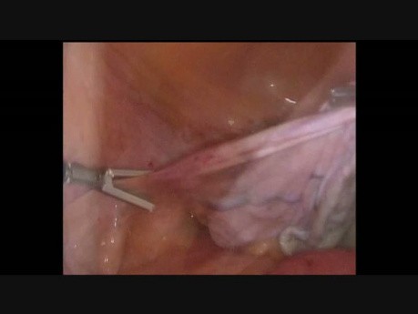 Postepowanie laparoskopowe przy dużej torbieli przydatków