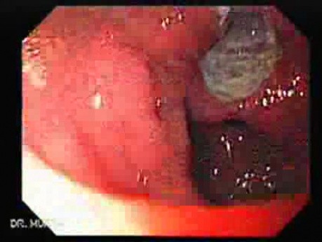 Wrzody u pacjenta z marskością wątroby - wielki wrzód części przedodźwiernikowej