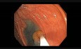 Kolonoskopia: jak przeprowadzić endoskopową resekcję śluzówkową - zmiana B