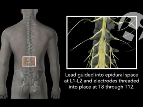 Umieszczanie stymulatora - odcinek lędźwiowy