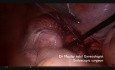 Miomektomia laparoskopowa - porady i triki