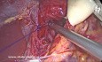 Chirurgie Anti-Reflux : Allongement de l’Oesophage Intra-Abdominal, Fermeture de la Hernie Hiatale, Cruroplastie