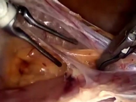Całkowita histerektomia laparoskopowa - standardowa technika