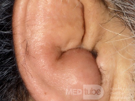 Idiopatyczna torbielowata chondromalacja małżowiny usznej