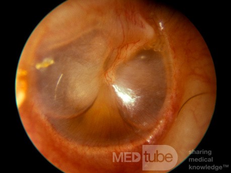 Surowiczego zapalanie ucha środkowego - poziom płynu i powietrza (ucho prawe)
