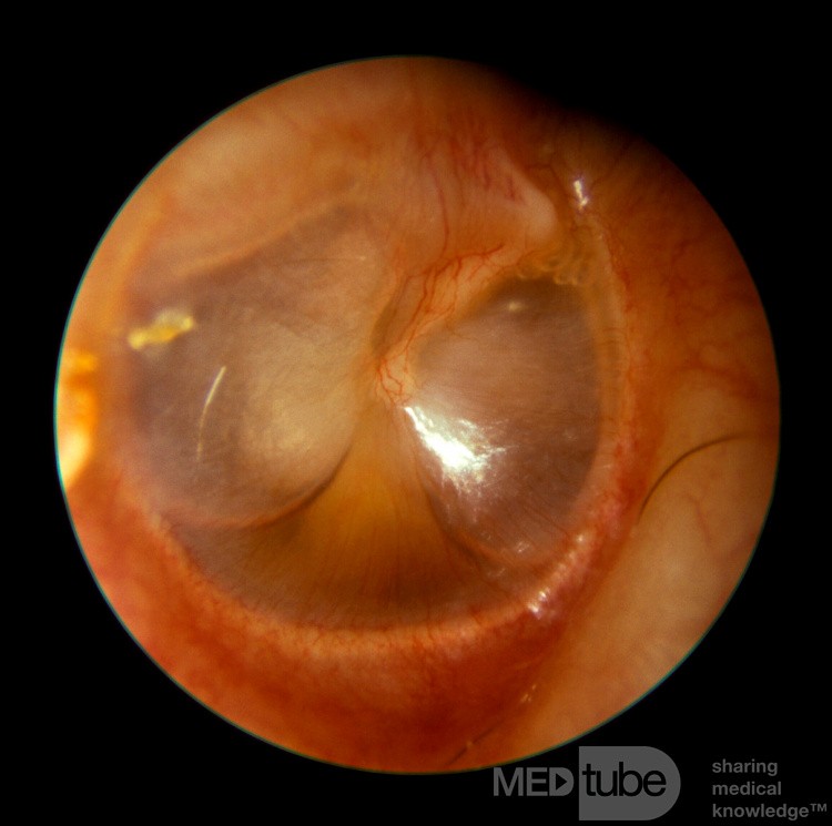 Surowiczego zapalanie ucha środkowego - poziom płynu i powietrza (ucho prawe)
