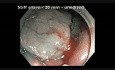 Kolonoskopia: endoskopowa resekcja śluzówkowa ząbkowanego polipa w poprzecznicy
