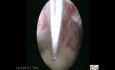 Histeroskopowe usunięcie polipa macicy