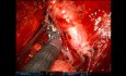 Uniportal RATS Completion Pneumonectomy After Two Previous Thoracotomies (Lobectomy and Lingulectomy)
