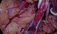 Laparoskopowa częściowa resekcja nerki 